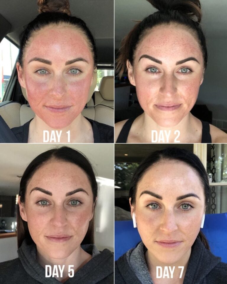 How Many Days After Microneedling Will I See Results?