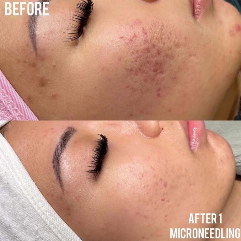 Can You See Results After 1 Microneedling?
